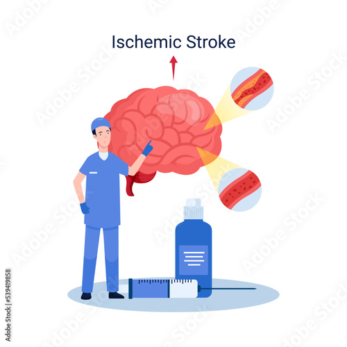 Ischemic stroke disease concept illustration