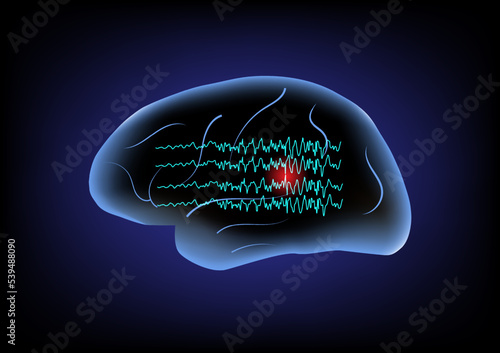 Illustration of human brain and brain waves. Concept of focal seizure.