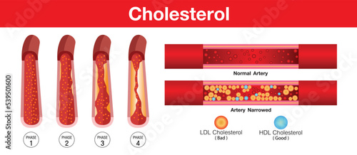 Cholesterol in artery, health risk , vector design