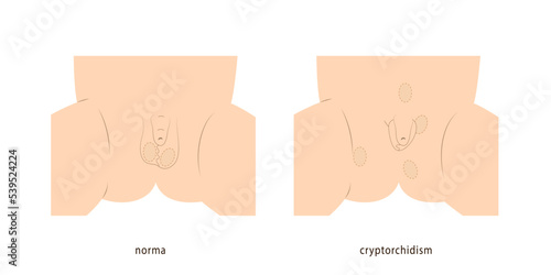 Medical illustration of little boy scrotum healthy and with undescended testicles demonstrating possible location of testicles.