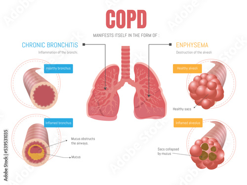 Epoc infographic: manifests itself in two forms emphysema and bronchitis 