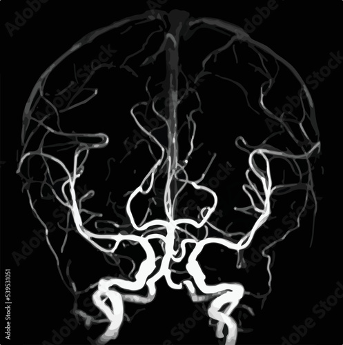 MR angiogram of cerebral arteries. photo