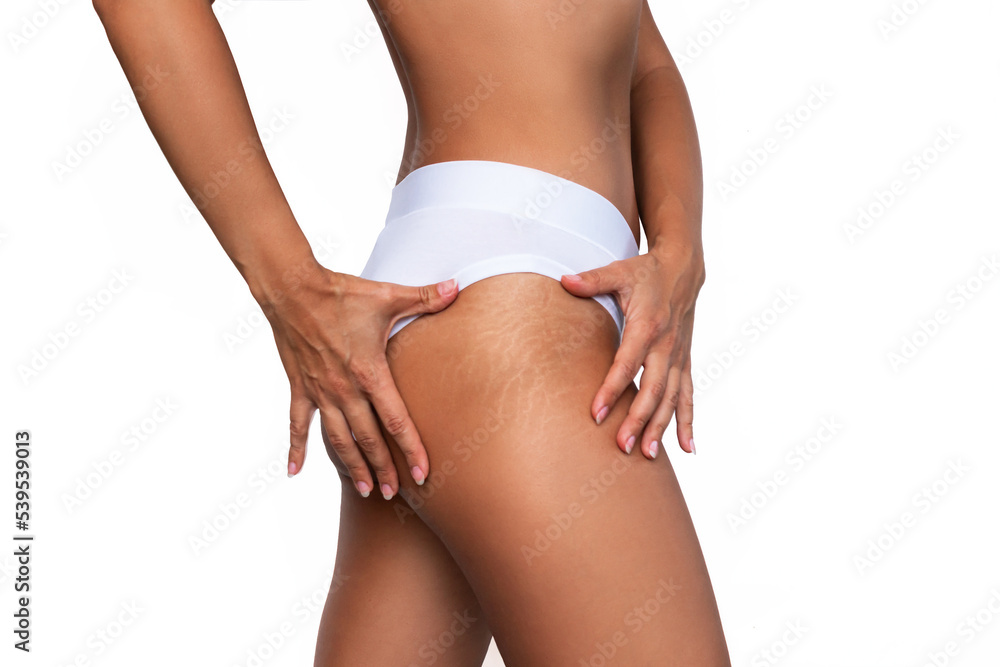 Cropped shot of young woman in white panties demonstrates stretch marks from a weight loss or weight gain on her thigh isolated on a white background. Body changes. Cosmetology, beauty concept - obrazy, fototapety, plakaty 