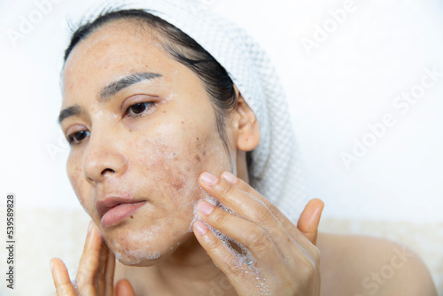Close up of  women having skin problems on white background. Women cleaning damage face skin burn after laser 
