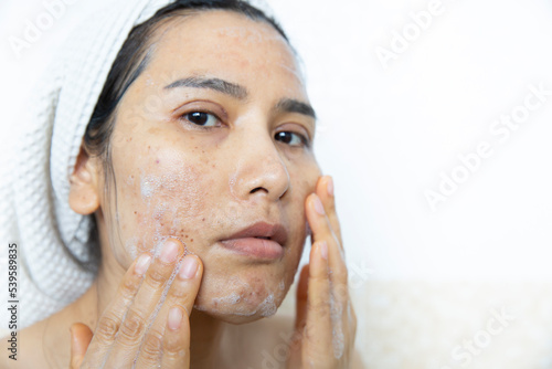 Close up of  women having skin problems on white background. Women cleaning damage face skin burn after laser 
