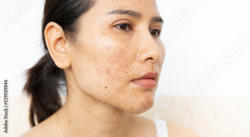 Close up of  women having skin problems on white background. W omen having damage skin burn after laser on her face