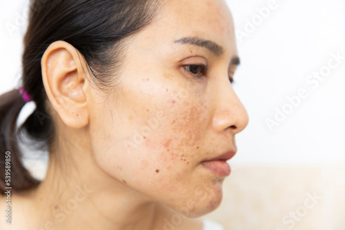 Close up of  women having skin problems on white background. W omen having damage skin burn after laser on her face