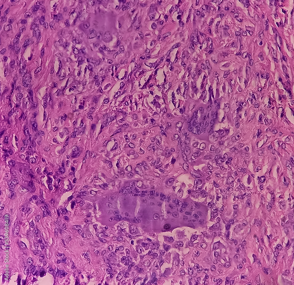 Finger Biopsy Photomicrograph Of Giant Cell Tumor Microscopic Show