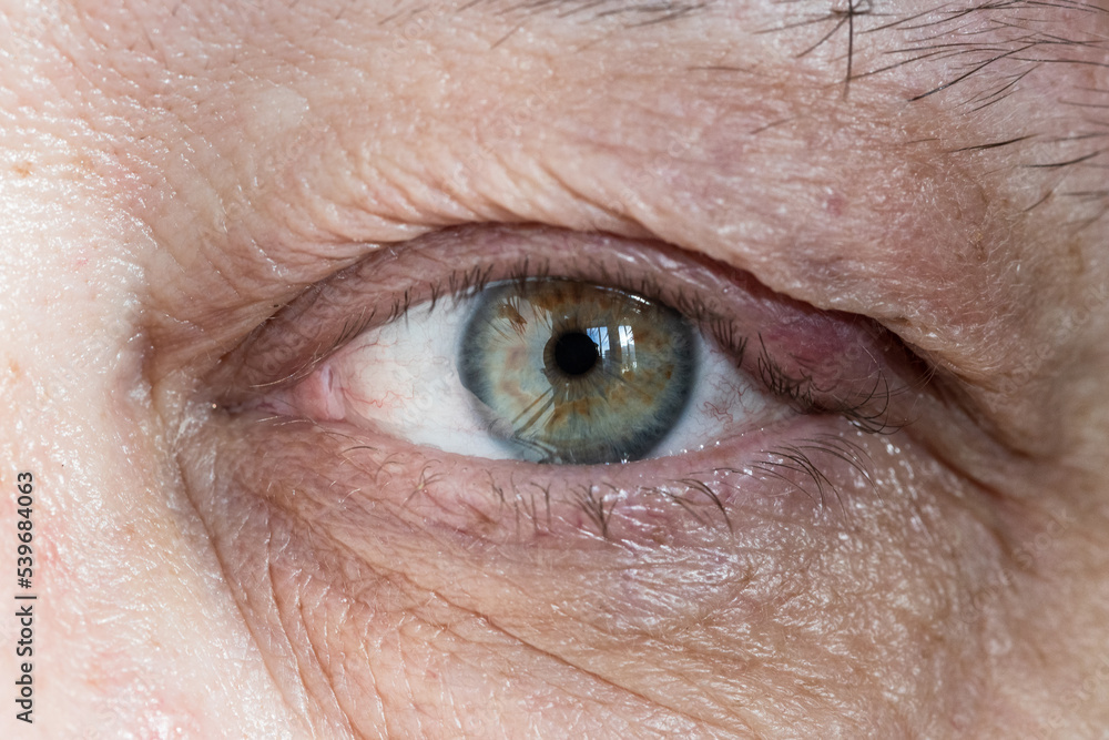 Fototapeta premium inflamed male eye with chalazion on eyelid from close up