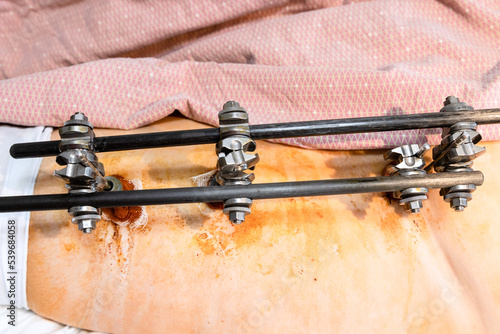 view of external fixation device on hip and pelvic in patient with pelvic fracture (focus on upper rod)