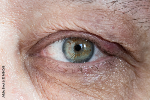 inflamed male eye with chalazion on eyelid from close up photo