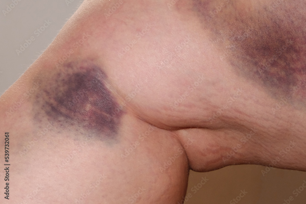 a large bruise on a person's leg. haematoma a large bruise on a person's leg. haematoma