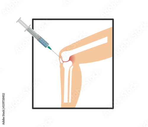 Knee Injection. stem cell therapy to the patient's knee. Treating knee pain by injection of platelet-rich plasma. Medical and cosmetology concept.
