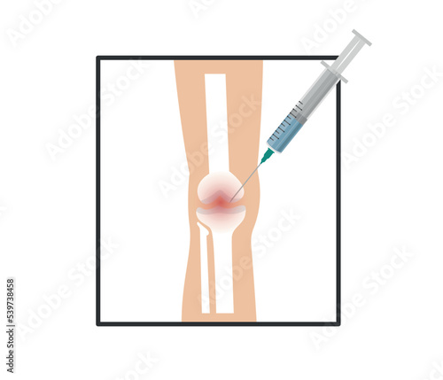 Knee Injection. stem cell therapy to the patient's knee. Treating knee pain by injection of platelet-rich plasma. Medical and cosmetology concept.
