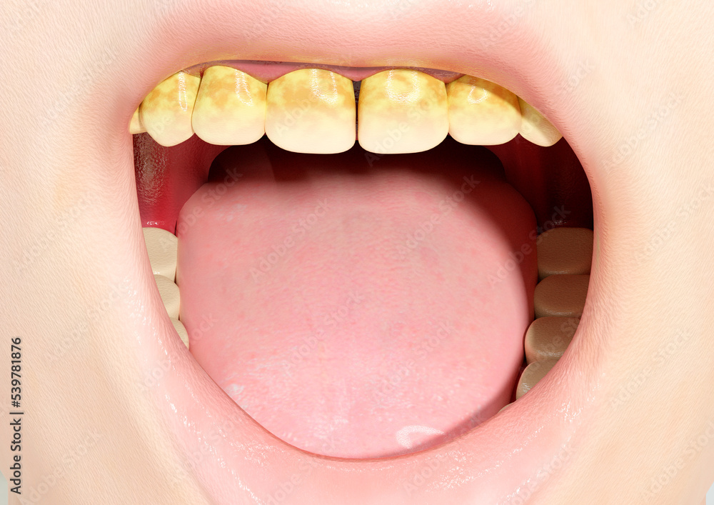 Obraz premium Tartar on human teeth causes calcification of the bacterial plaque that covers the teeth and part of the gums