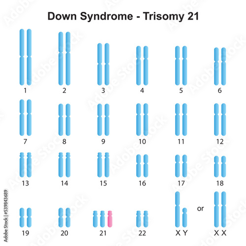 Scientific Designing of Down Syndrome  Trisomy 21  Karyotype. Colorful Symbols. Vector Illustration.