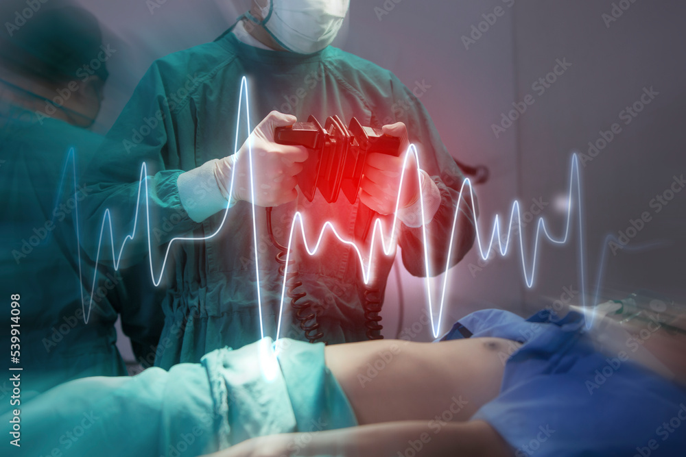 Doctor Professor holding paddles and about to perform CPR on a patient using a defibrillator. - obrazy, fototapety, plakaty 
