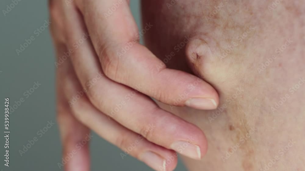 Protruding navel in a pregnant woman. Stretched skin around the navel, macro Protruding navel in a pregnant woman. Stretched skin around the navel, macro