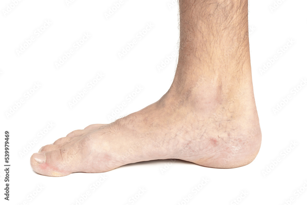 Foot of a man's leg with varicose veins, isolated on white background
