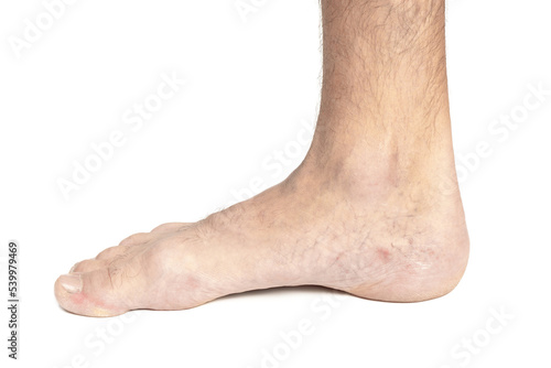 Foot of a man's leg with varicose veins, isolated on white background © andrei310