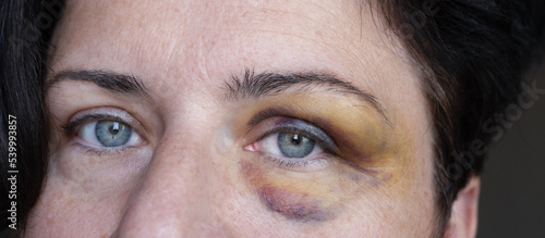Close up of bruised woman eye. Face of a woman with a hematoma photo