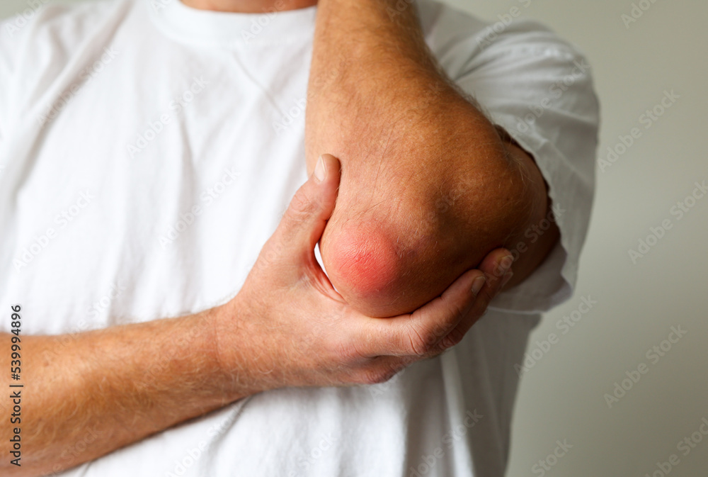 Man swelling erythematous lump pain elbow from Olecranon bursitis