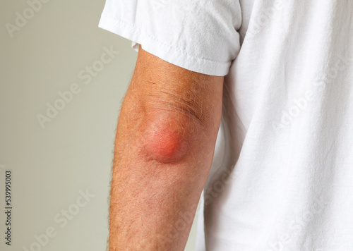 Man swelling erythematous lump pain elbow from Olecranon bursitis, student elbow medical condition. Inflammation of the bursa located under the elbow Olecranon trauma or repetitive smaller traumas.  photo