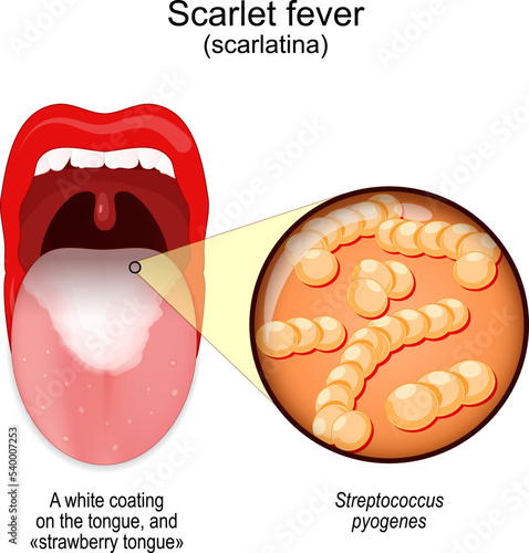 Scarlet fever. mouth with symptoms of scarlatina.