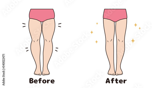 Leg diet, before and after set.