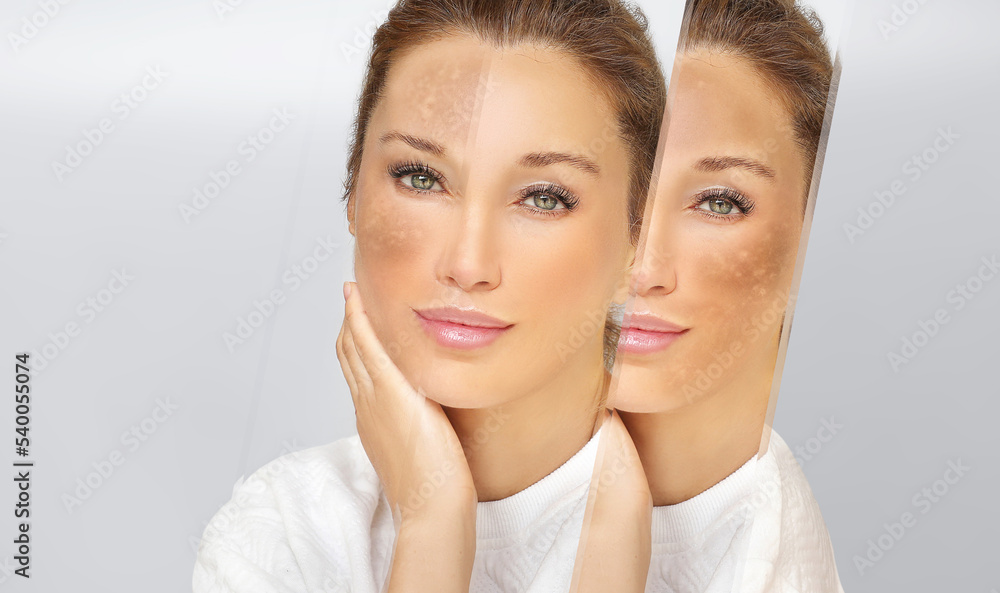 Dark spots, freckles,hyperpigmentation(melasma or chloasma),concept - skin lightening, skin whitening, fruit acids,AHA, Skin Brightening Dark spots, freckles,hyperpigmentation(melasma or chloasma),concept - skin lightening, skin whitening, fruit acids,AHA, Skin Brightening