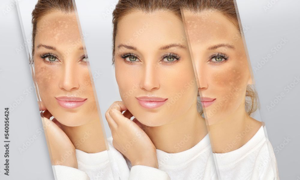 Dark spots, freckles,hyperpigmentation(melasma or chloasma),concept - skin lightening, skin whitening, fruit acids,AHA, Skin Brightening Dark spots, freckles,hyperpigmentation(melasma or chloasma),concept - skin lightening, skin whitening, fruit acids,AHA, Skin Brightening