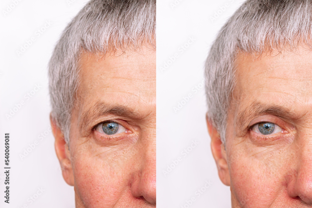 Cropped shot of a elderly caucasian man's face with drooping upper eyelid before and after blepharoplasty isolated on white background. Result of plastic surgery. Changing the shape, cut of the eyes - obrazy, fototapety, plakaty 