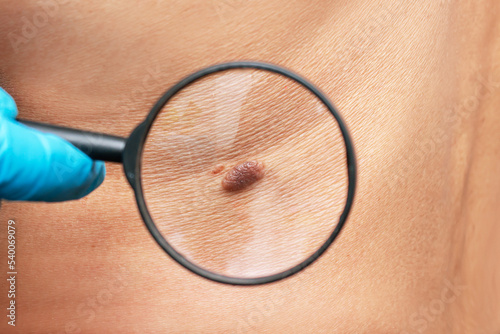 Close-up of a big mole on a man's skin magnified with a magnifying glass. The doctor conducts a medical examination