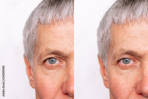 Cropped shot of a elderly caucasian man's face with drooping upper eyelid before and after blepharoplasty isolated on white background. Result of plastic surgery. Changing the shape, cut of the eyes photo