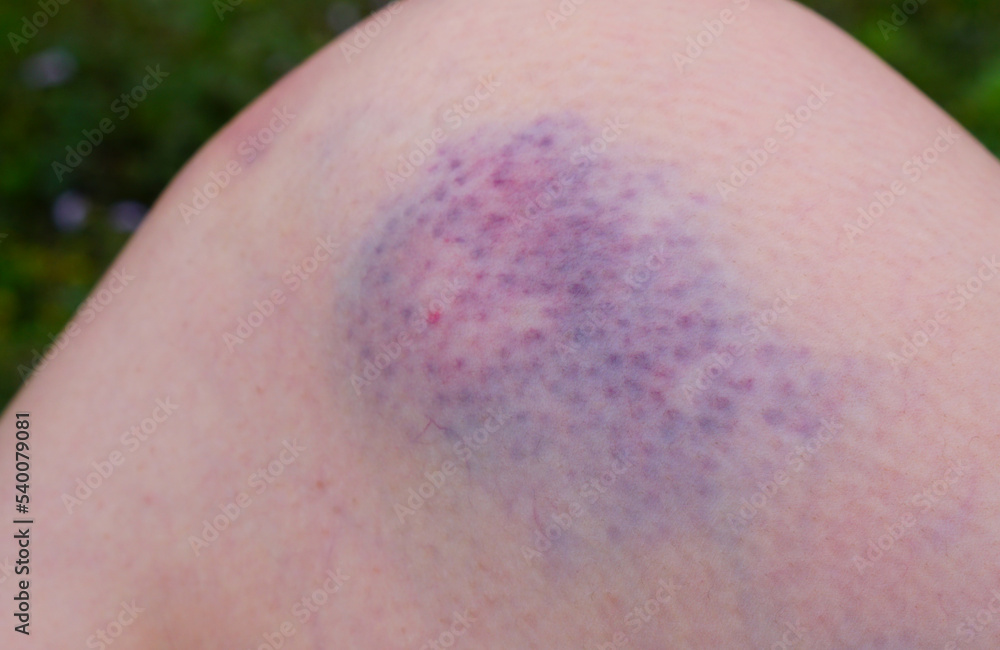 Fototapeta premium Visible purple bruise on knee after accident