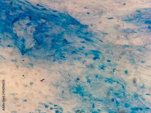 Sputum or phlegm smear AFB stain under microscopy showing Macrobacterium Tuberculosis Bacteria (MTB).