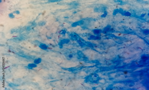 Canvas Print Sputum or phlegm smear AFB stain under microscopy showing Macrobacterium Tuberculosis Bacteria (MTB)