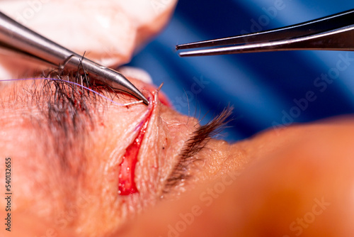 basra, iraq - August 12, 2022: closeup photo of blepharoplasty eyelid surgery photo