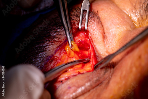 basra, iraq - August 12, 2022: closeup photo of blepharoplasty eyelid surgery