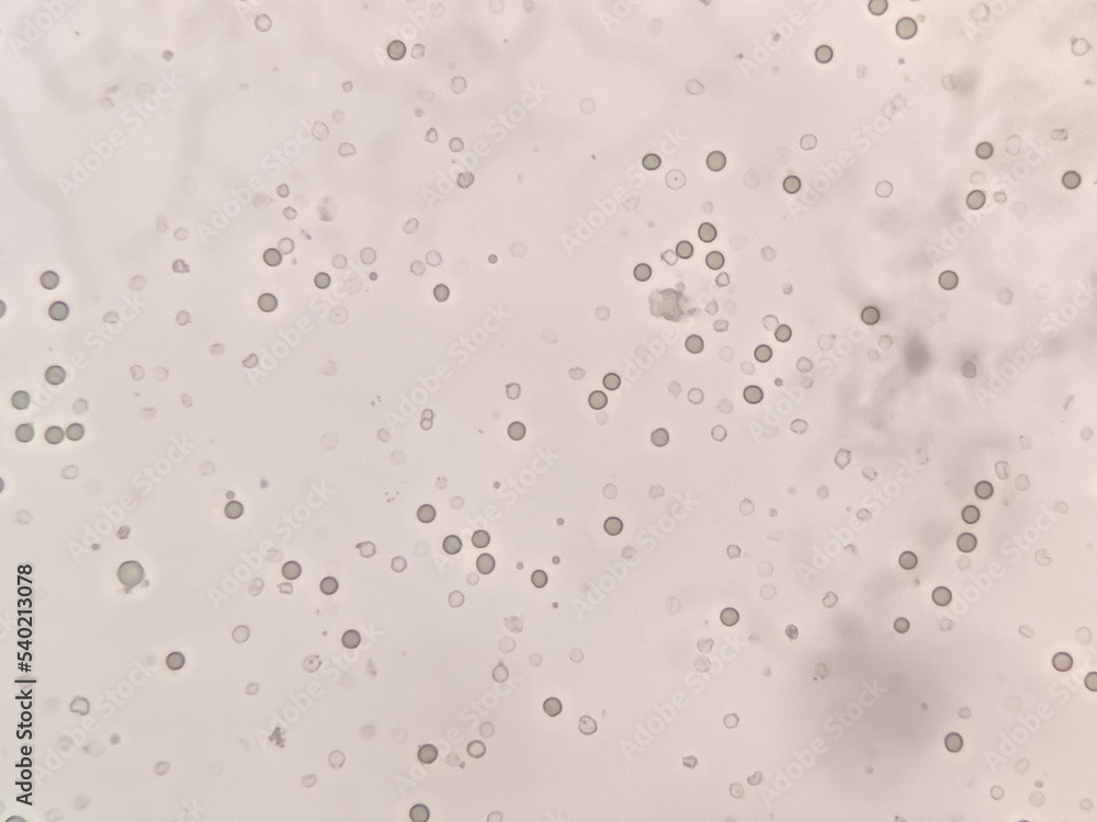 Abnormal result of urinalysis examination from microscopic method under