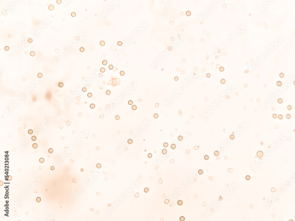 Abnormal result of urinalysis examination from microscopic method under