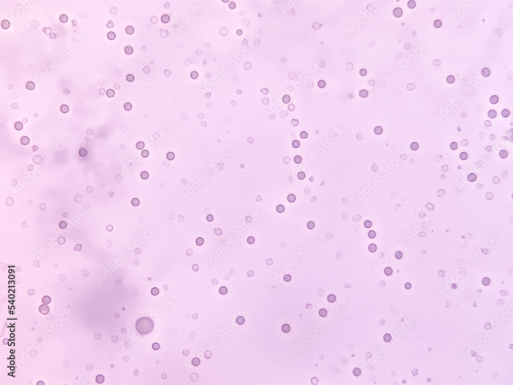 Abnormal result of urinalysis examination from microscopic method under