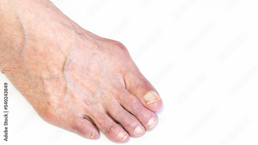 Bunion or hallux valgus on senior woman foot. Deformity of the joint