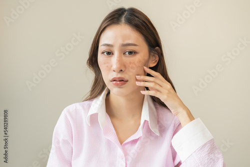 Slika na platnu Dermatology, expression face worry, stressed asian young woman hand touching facial at dark spot of melasma, freckles from pigment melanin, allergy sun