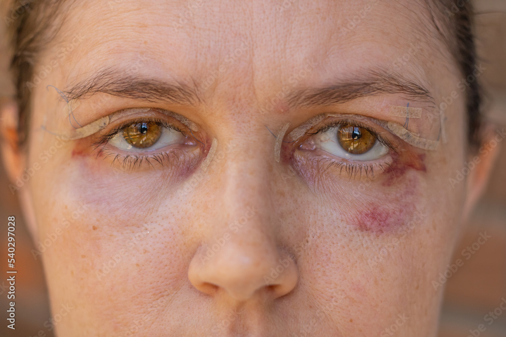 Double Eyelid Surgery Eyes Surgery Recover Period Immediately After double-eyelid-surgery-eyes-surgery-recover-period-immediately-after