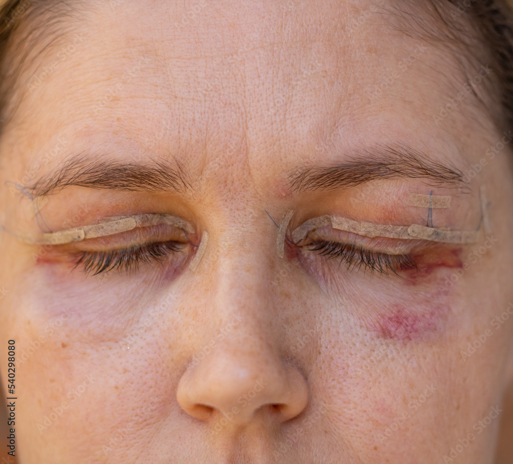 Double Eyelid Surgery, Eyes Surgery Recover Period, immediately after