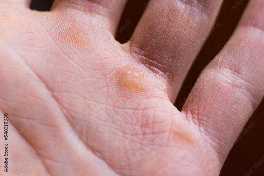 Calluses, skin injury on the hand close-up Calluses, skin injury on the hand close-up