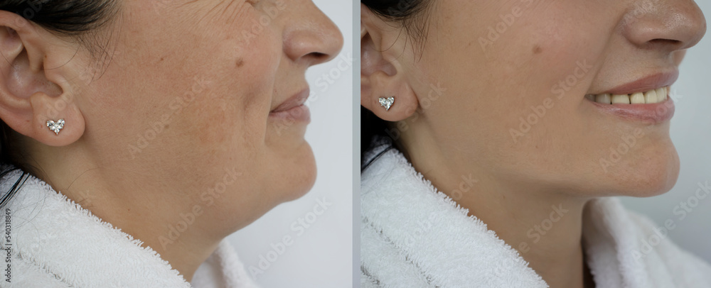 Woman double chin before and after treatment - obrazy, fototapety, plakaty 