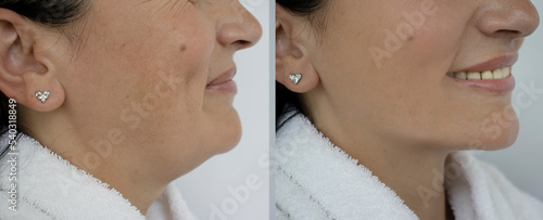 Woman double chin before and after treatment