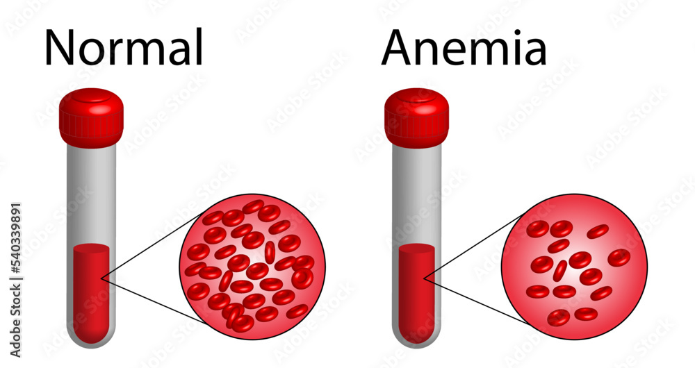 Iron deficiency anemia. The difference of Anemia amount of red blood